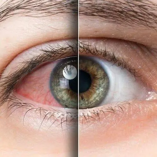 Dry Eye Disease