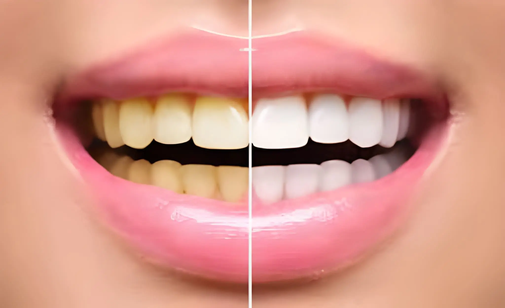 Teeth Whitening
