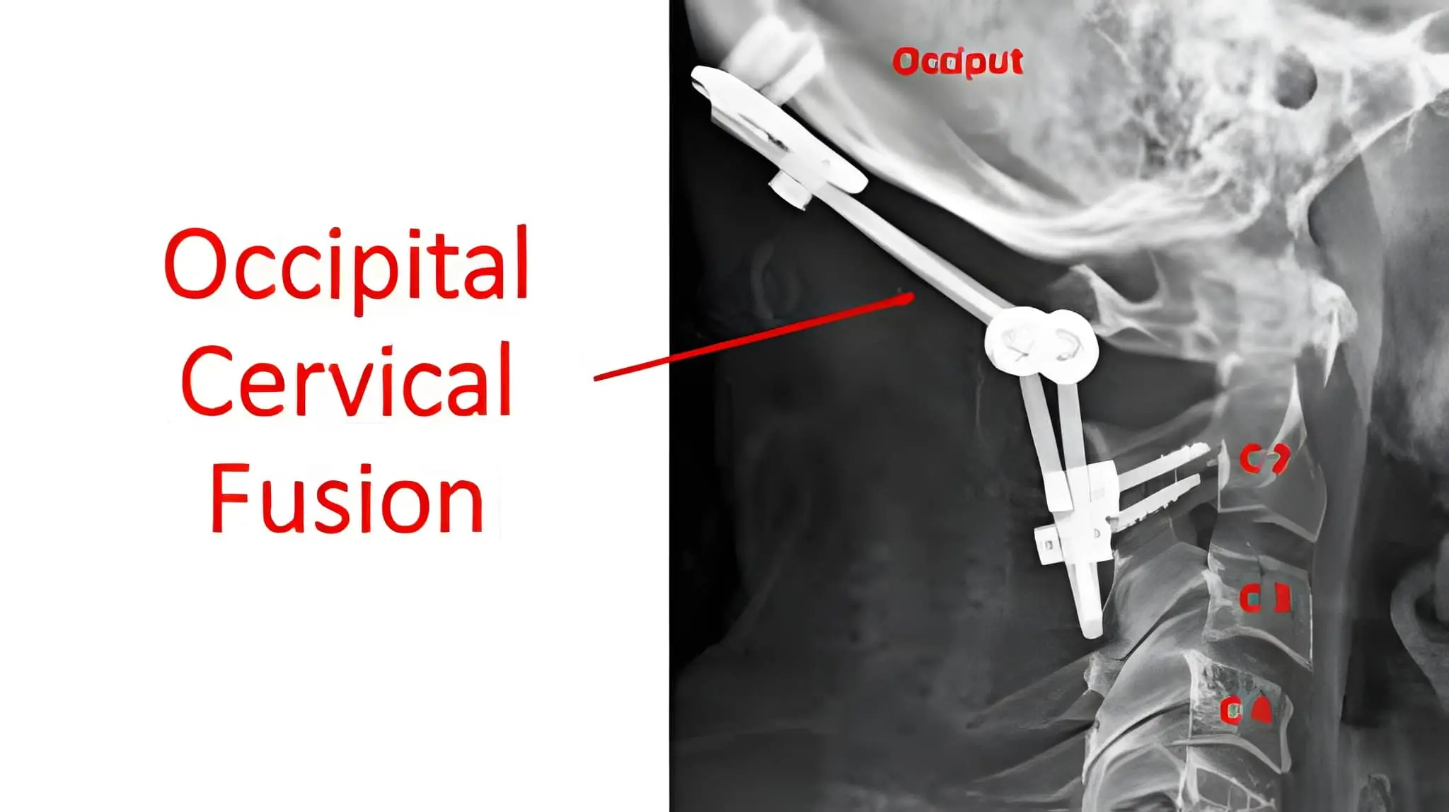 C1-C2 Fusion Surgery
