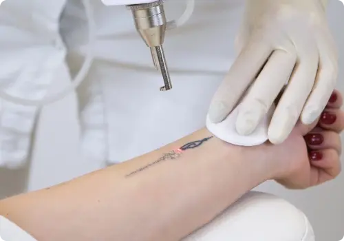 Tattoo Removal