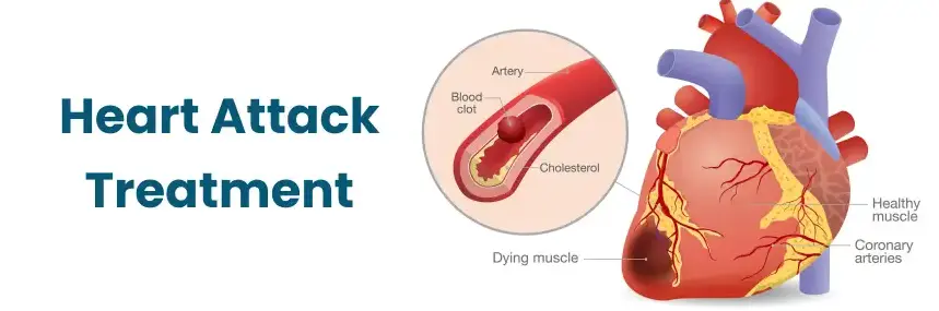 Heart Attack Treatment