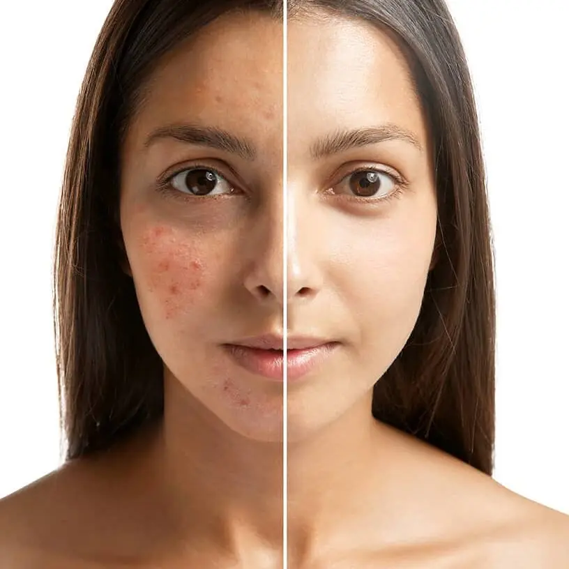 Acne Scar