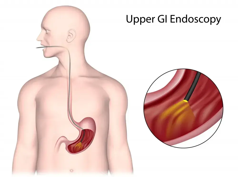 Endoscopy