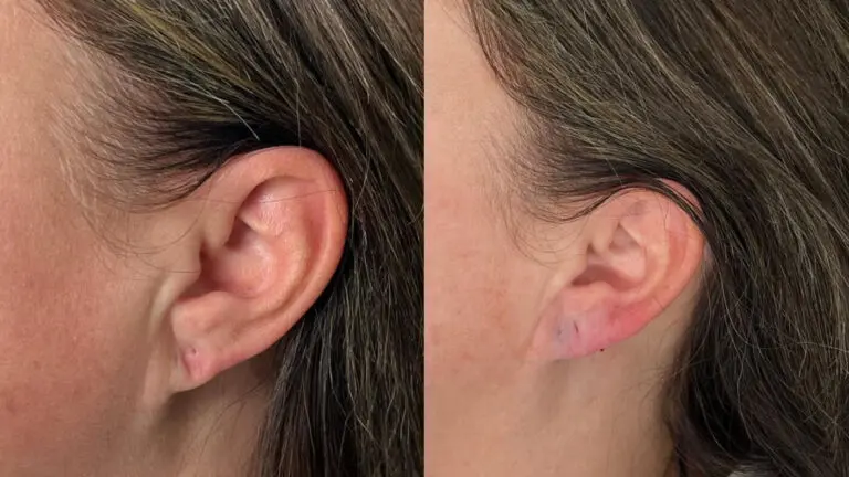 Earlobe Correction for Torn and Damaged Ear Lobes