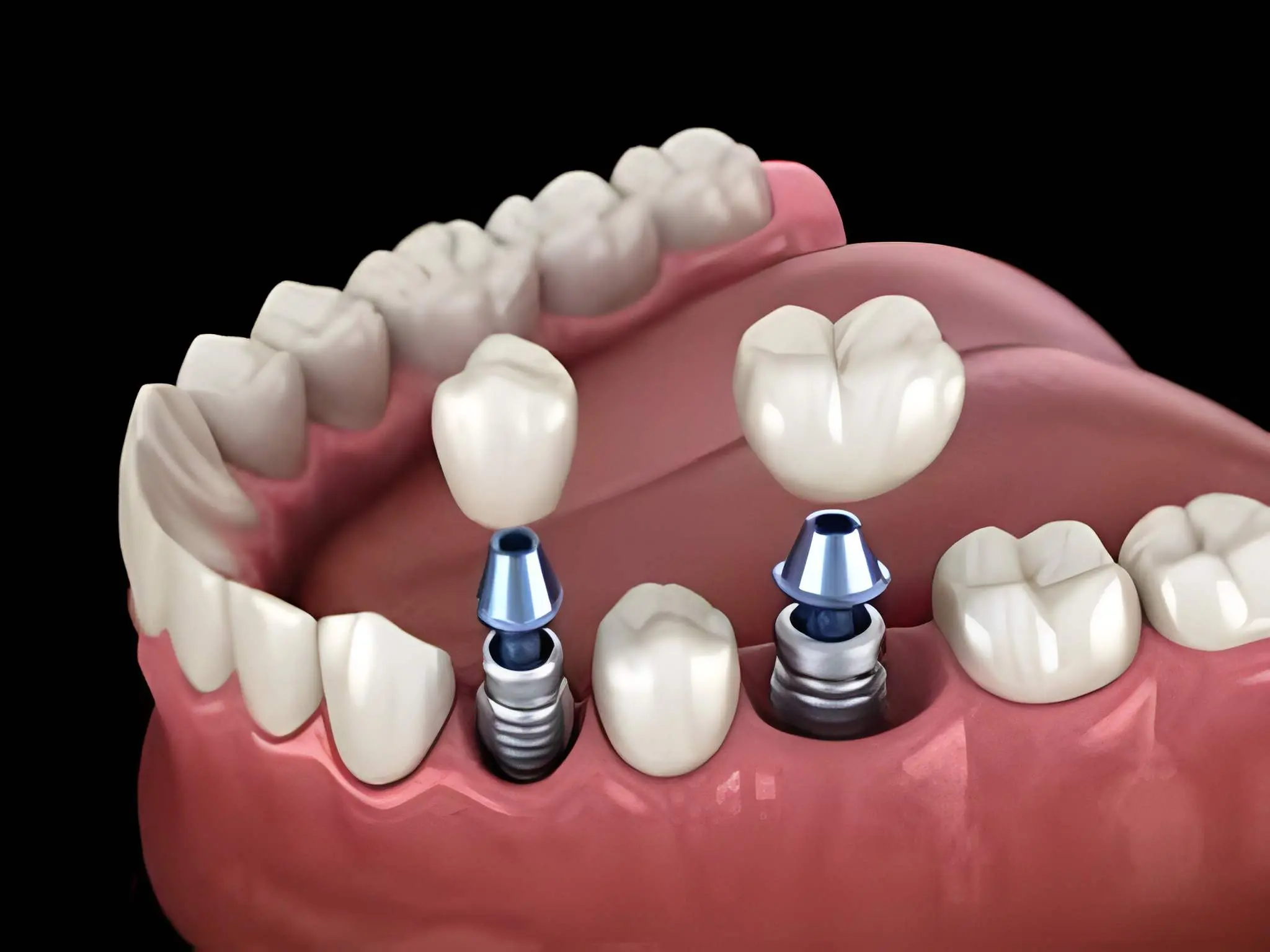 Dental Implants