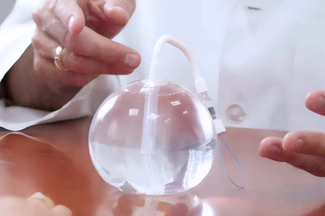 Does Allurion Gastric Balloon Clinic bring visible slimming outcomes?