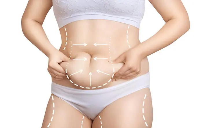 Can Liposuction Bring a New Era of Body Shaping Perfection?