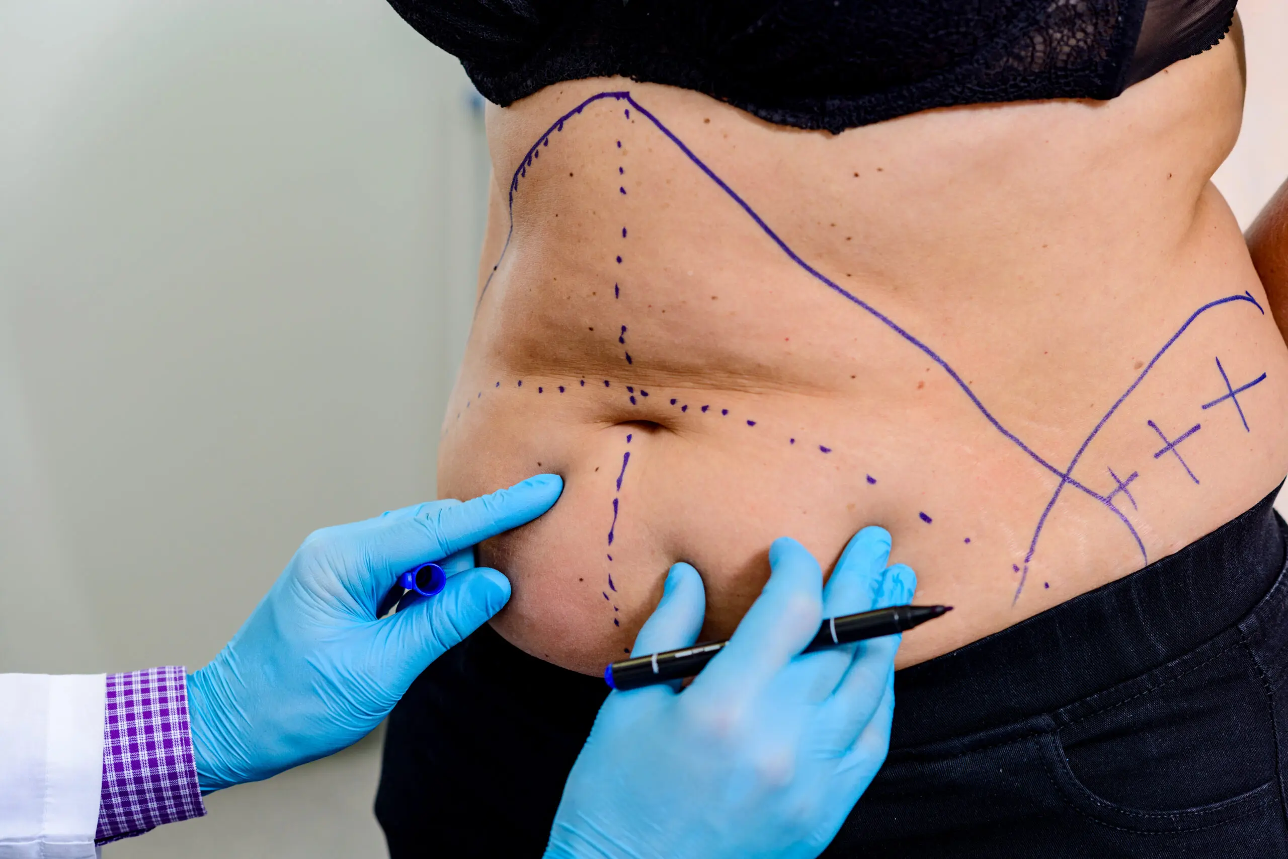 Liposuction in Dubai Featuring Innovative Solutions