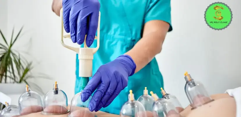 Cupping Therapy
