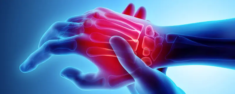 Arthritis
