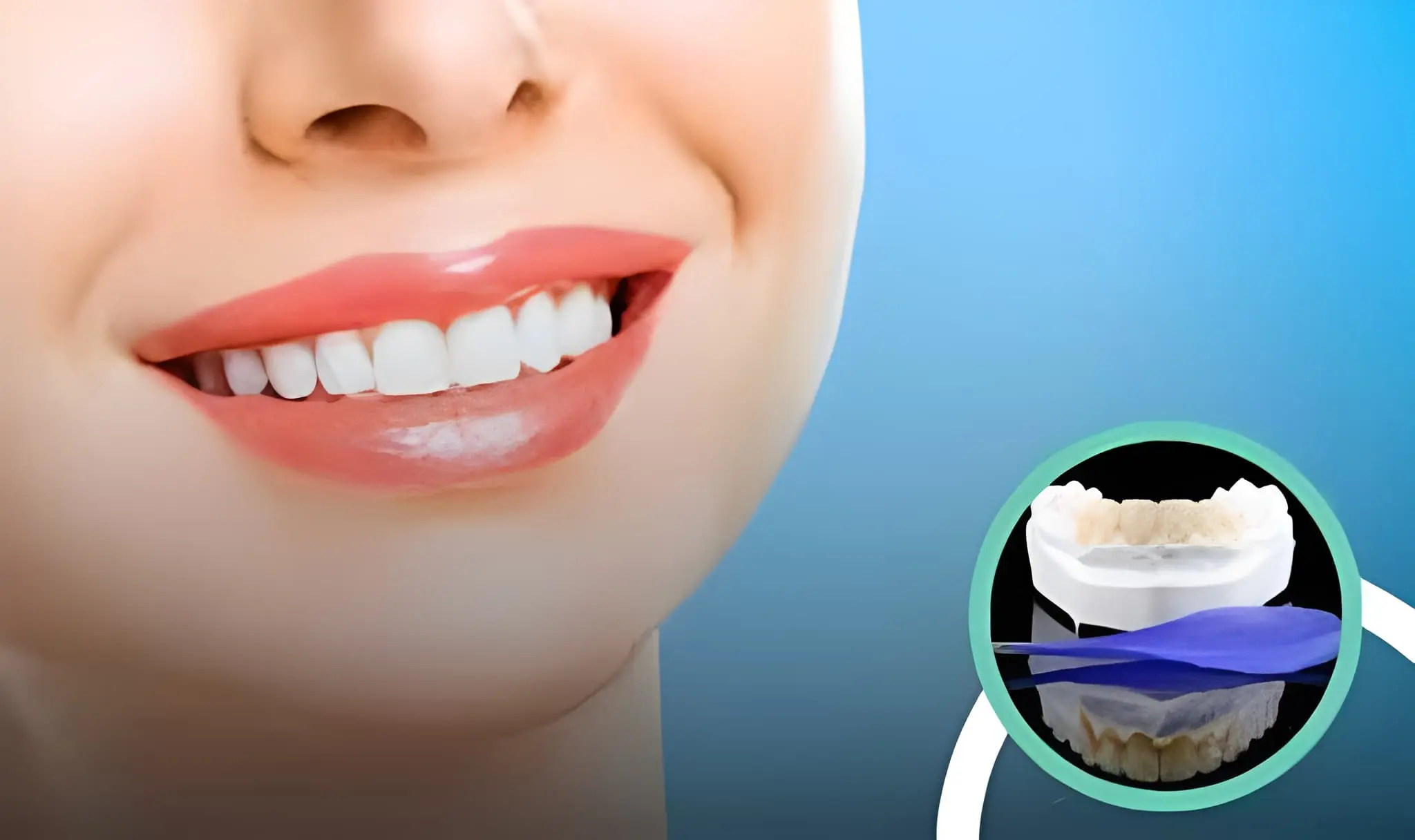 Smile Makeover