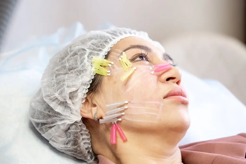 Can PDO Mono Threads Reinforce Facial Skin Support Layers?