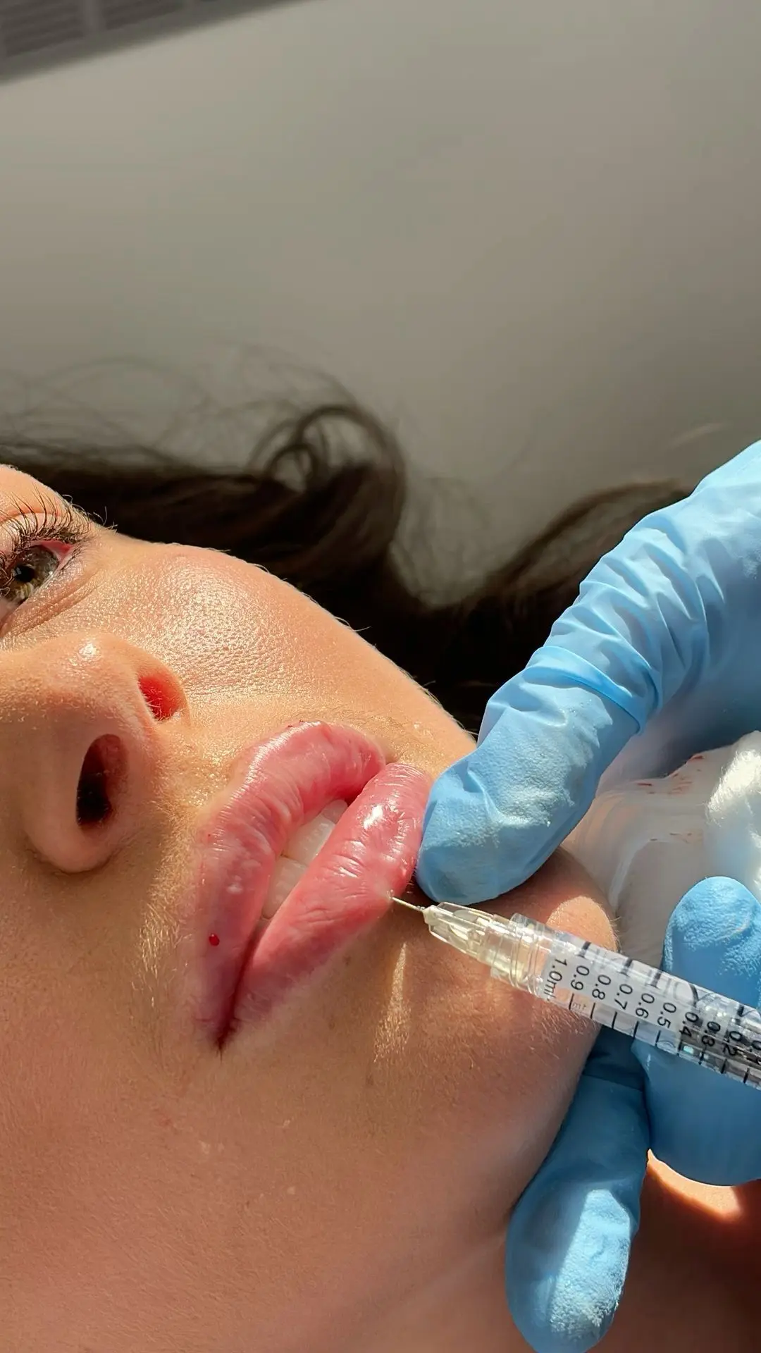 What Role Do Lip Fillers Play In Enhancing Lip Structure?