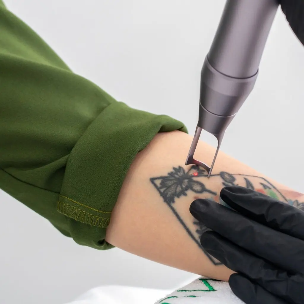 How Does Laser Tattoo Removal Break Down Ink Particles in Skin?