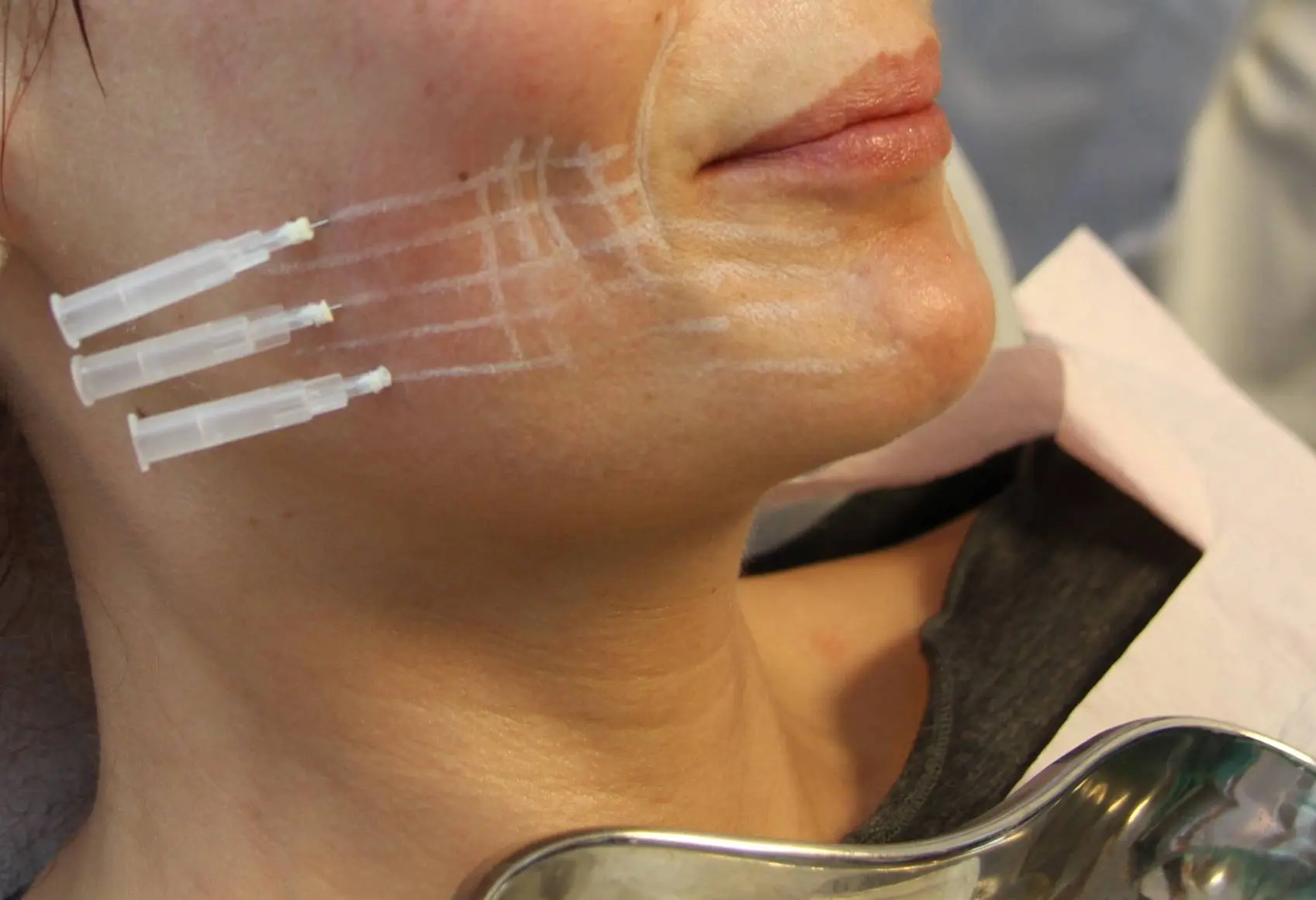 Do PDO Mono Threads Support Gradual Skin Tightening?