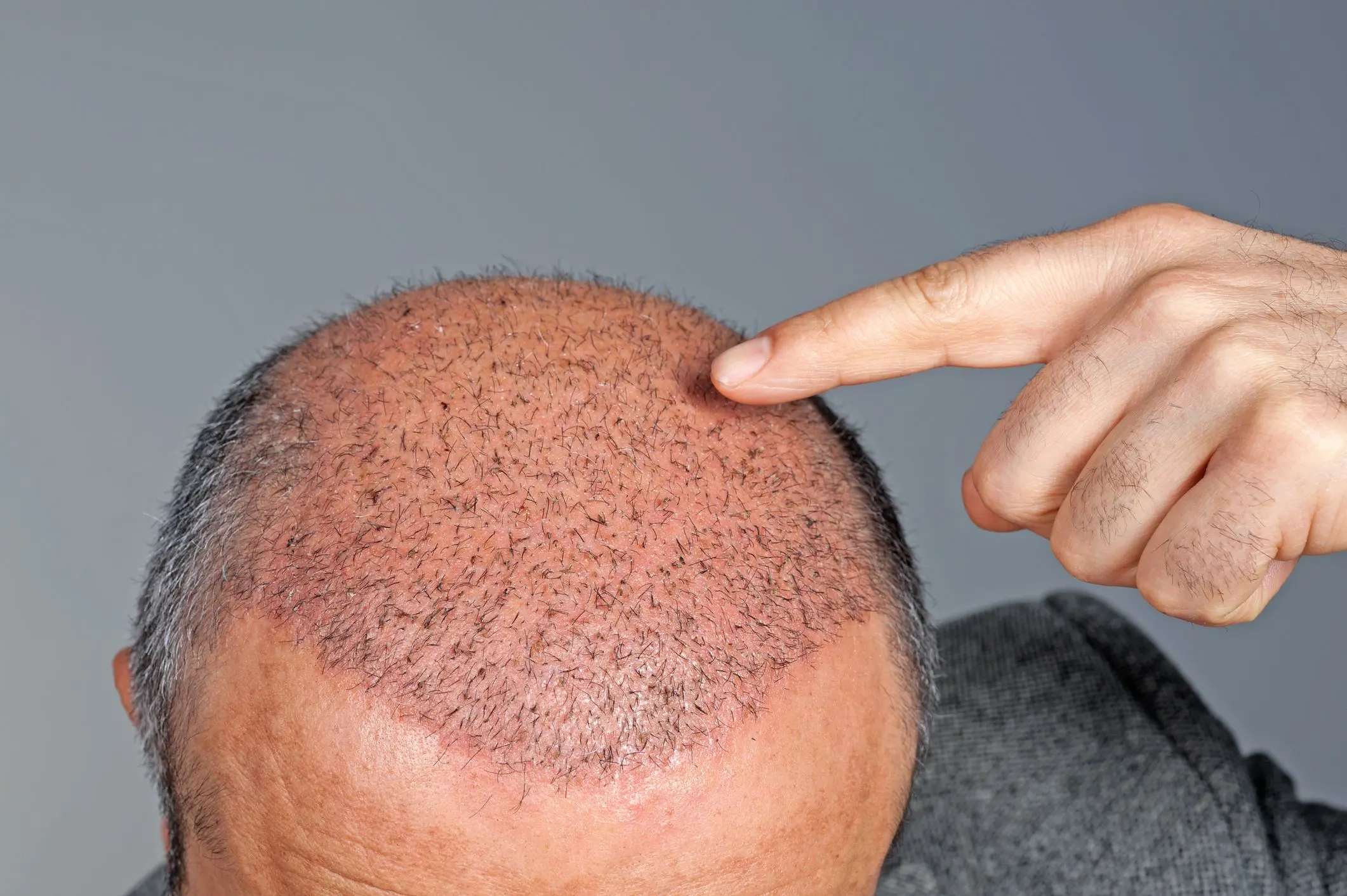 What Makes Hair Transplant A Breakthrough For Hair Loss?