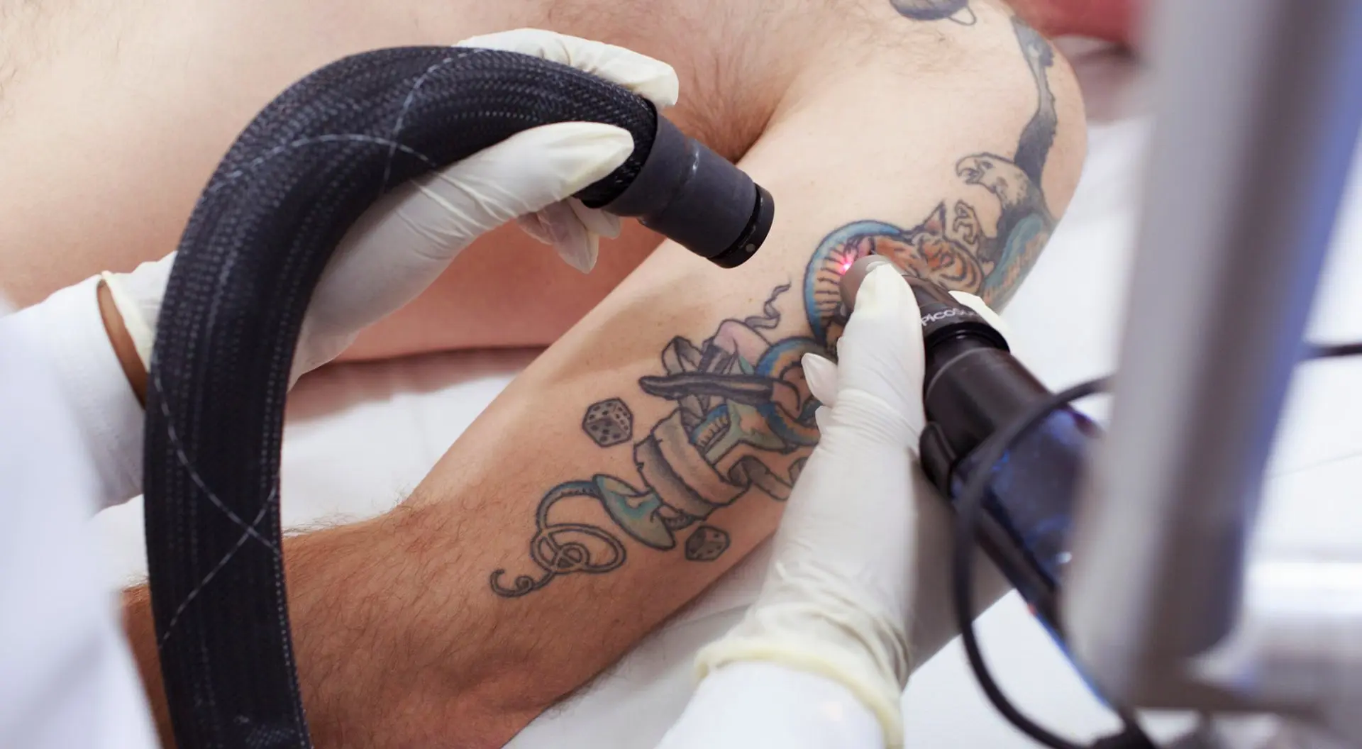 Why Do People Choose Laser Tattoo Removal Today?