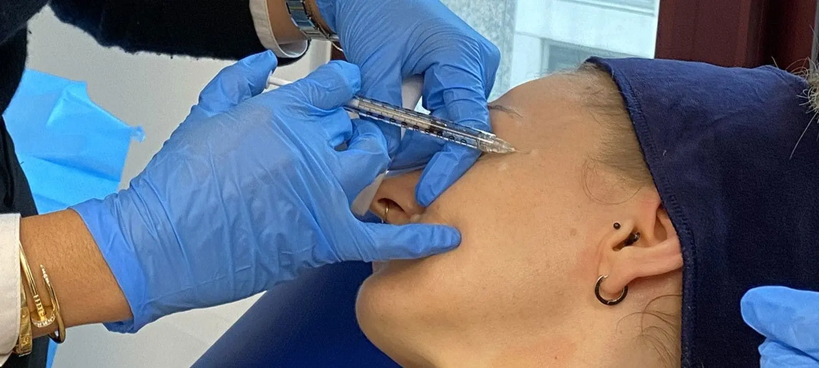 How Do Cheek Fillers Restore Mid-Face Volume Loss?