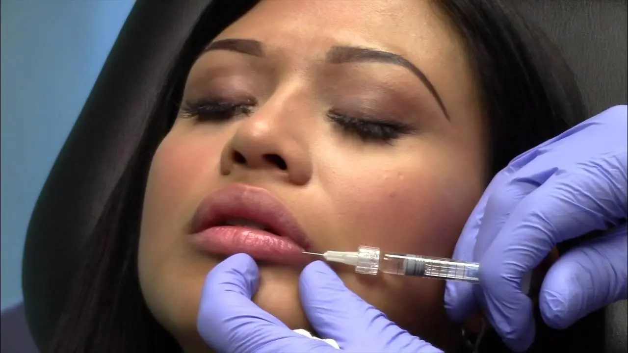 How Long Do Lip Fillers Last Before Needing a Touch Up?