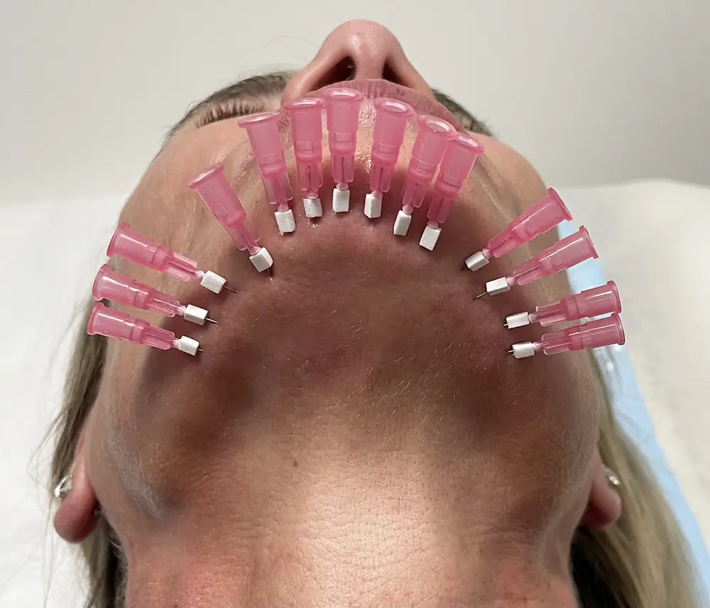 What Skin Problems Can PDO Mono Threads Actually Treat?