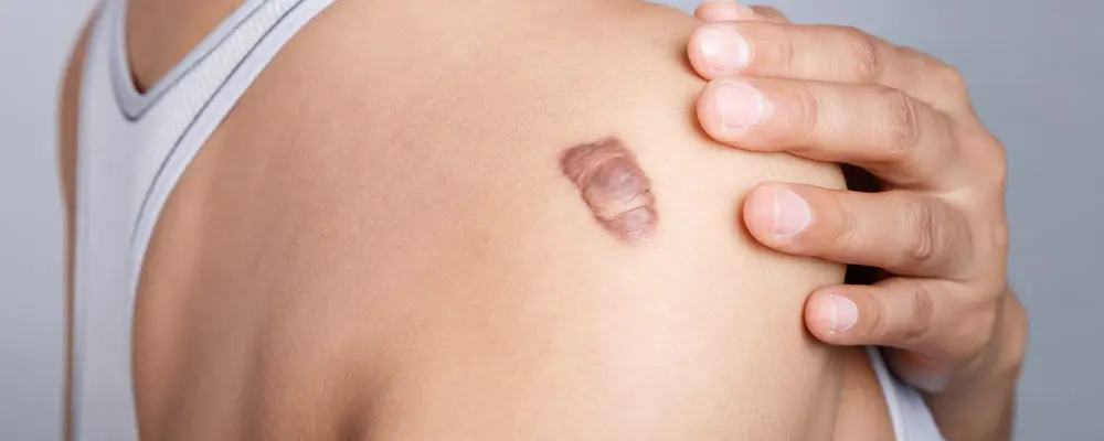 Can Keloid Treatment Stop Scars From Growing Bigger?
