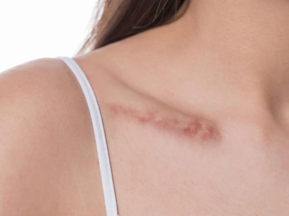 Do Scar Removal Solutions Help With Stubborn Scars?