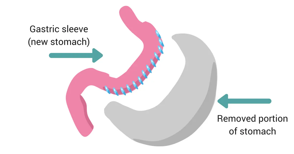 How Does Gastric Plication Help With Weight Loss?