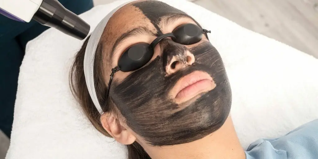 Is Laser Carbon Peel the Best Solution for Persistent Acne Marks?