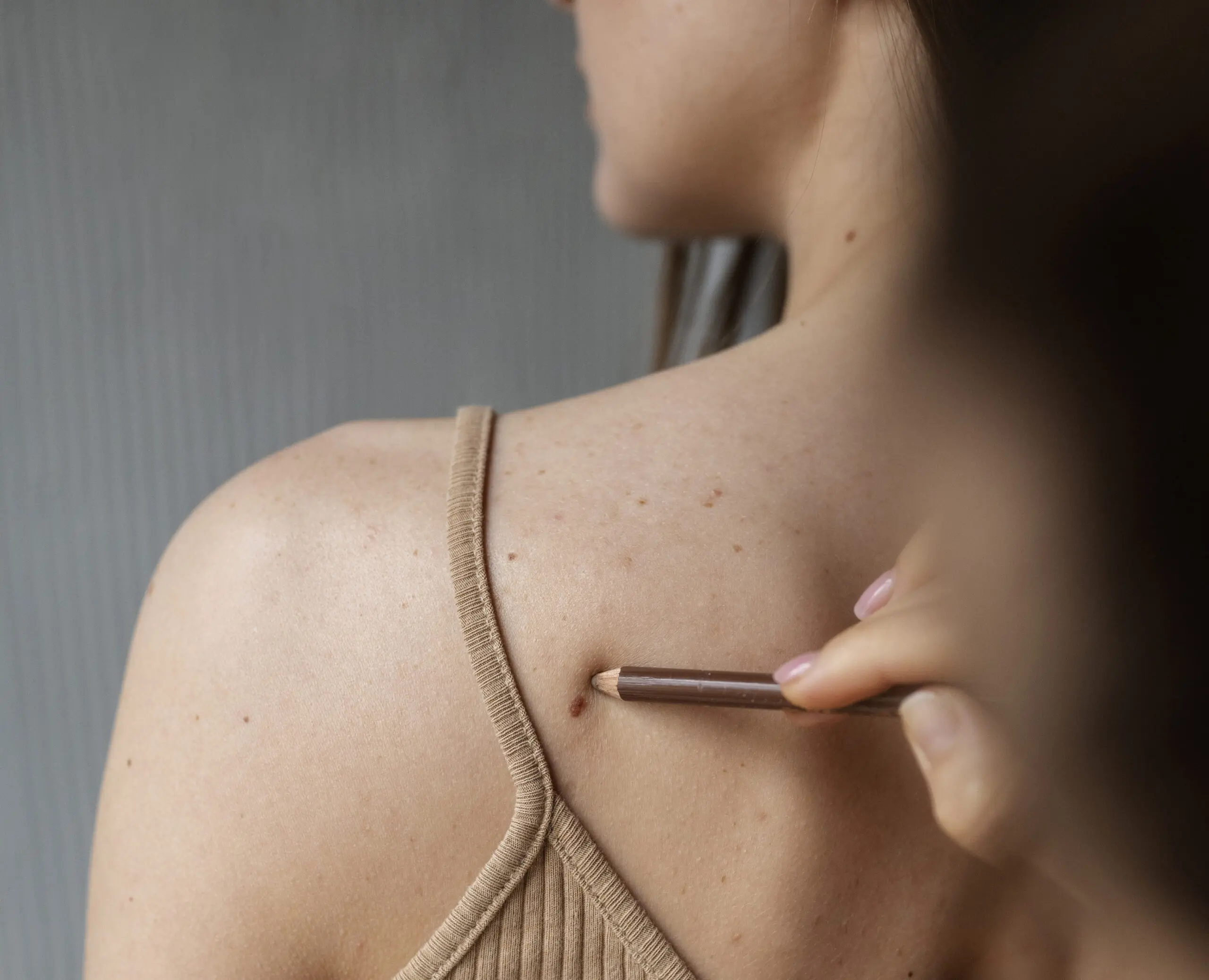 How Does Skin Tag Removal Improve Skin Appearance?