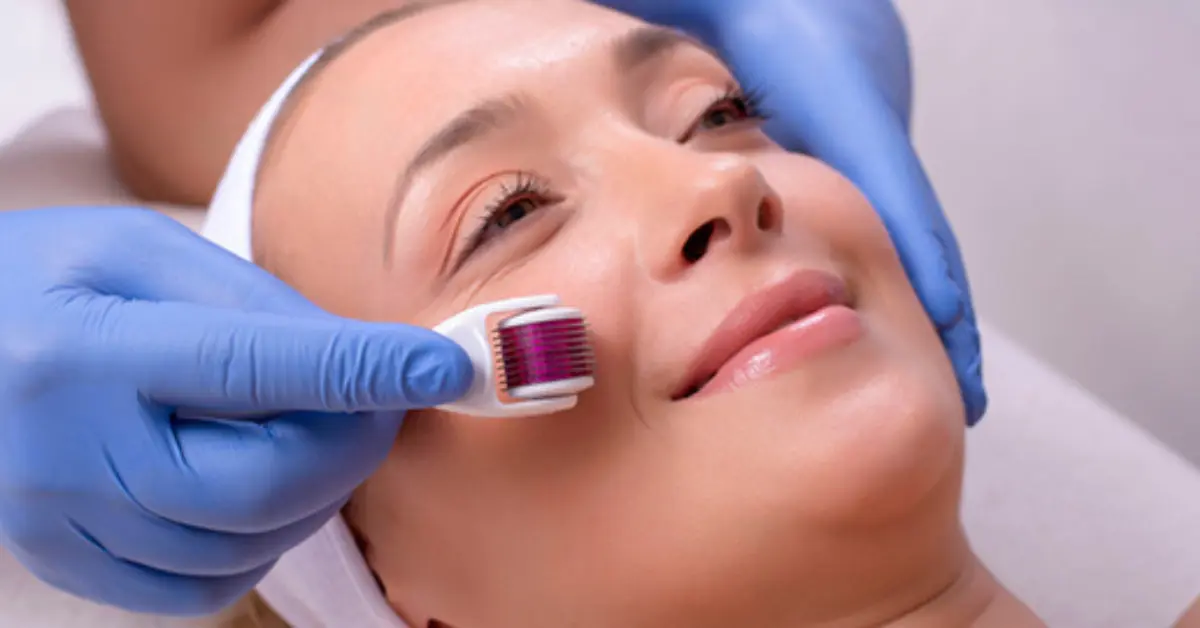 What Makes Microneedling Effective Against Fine Lines?