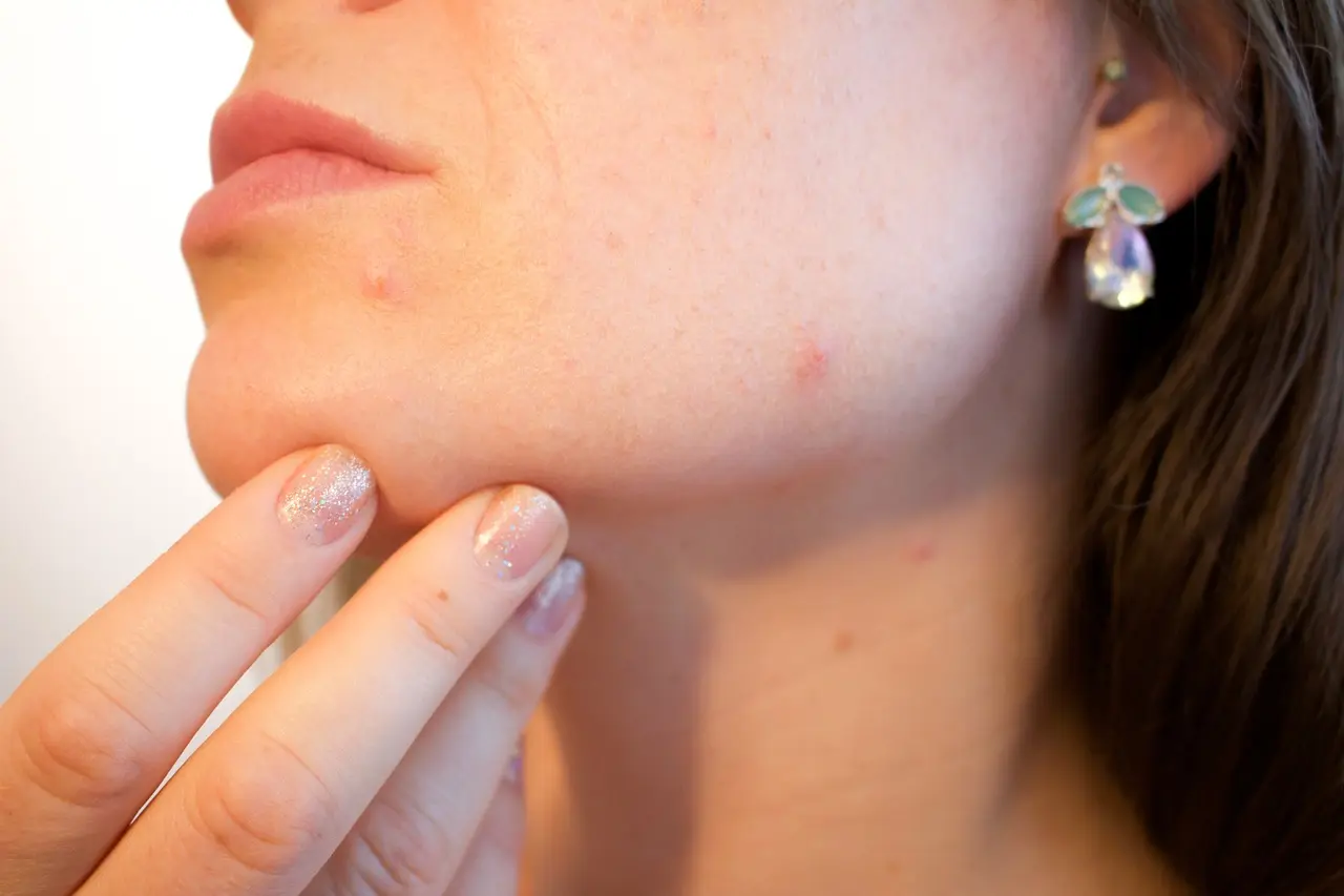 Can Acne Treatment Control Current Pimples and Future Outbreaks?