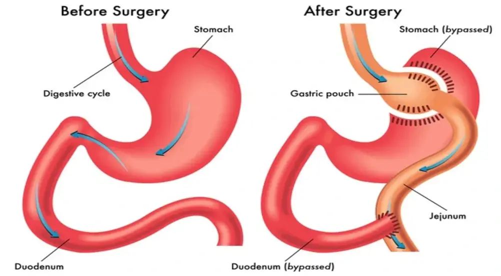 What Should You Expect After Gastric Bypass Surgery?