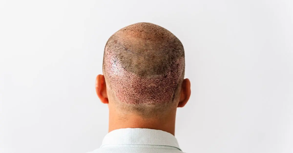 How Does Hair Transplant Reduce Visible Scarring on Scalp?