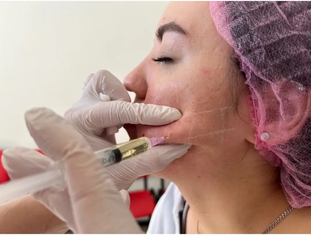 How Do I Know If I Need Dermal Fillers or Not?