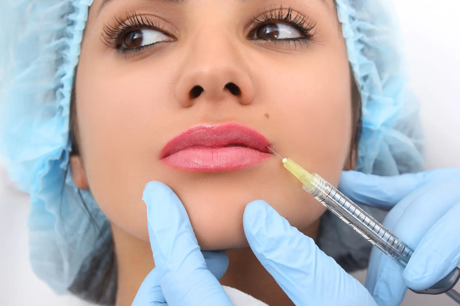 How Many Syringes Do Russian Lip Fillers Need?