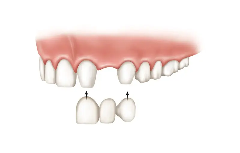 Replacement of missing tooth