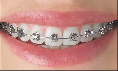 Orthodontic treatments