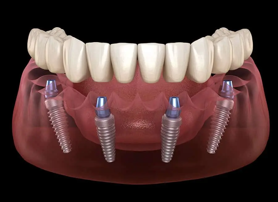 Dental implants