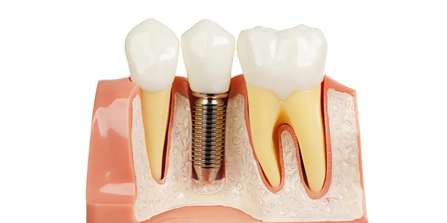 Dental Implants