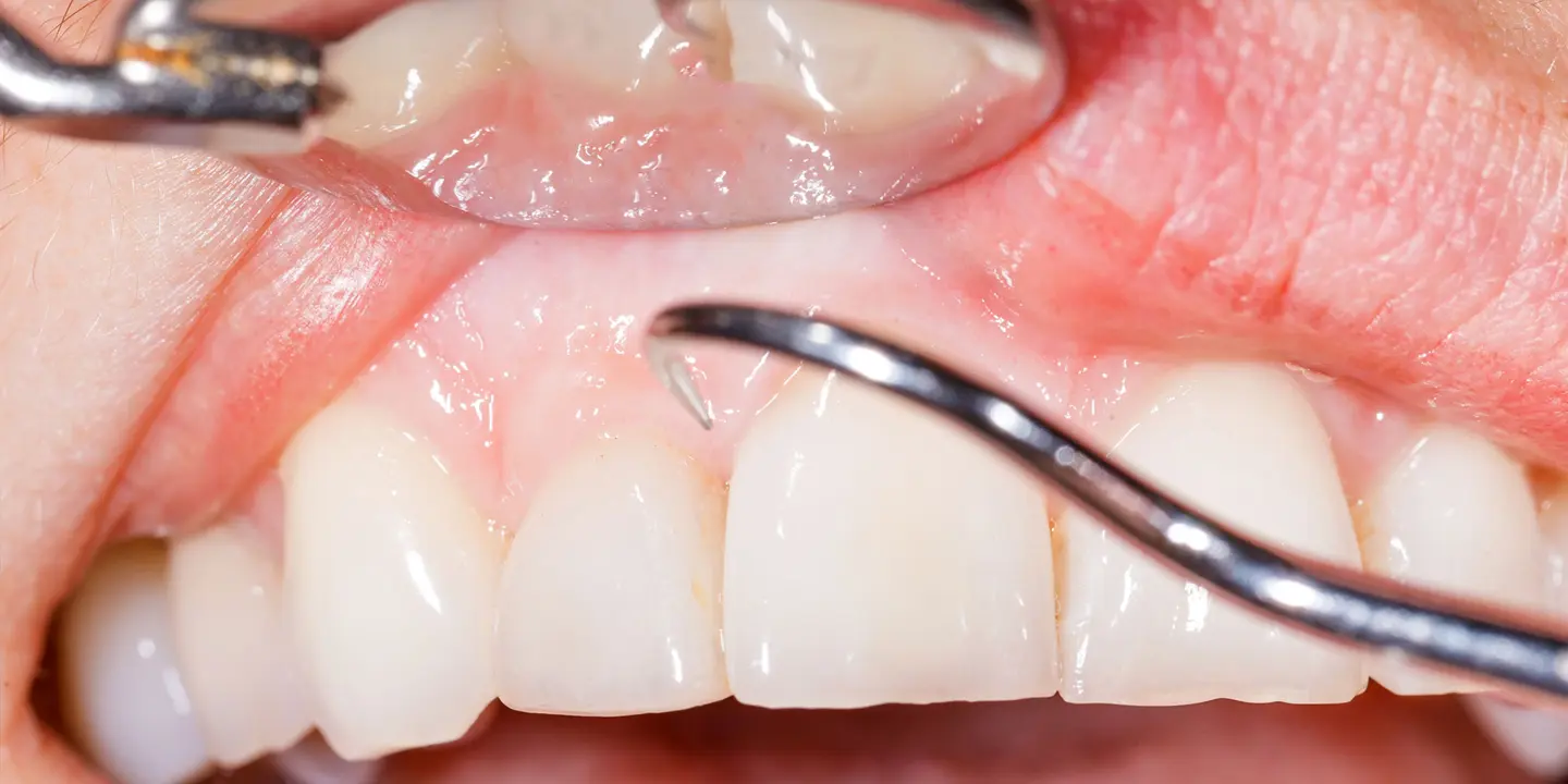 Flap Surgeries