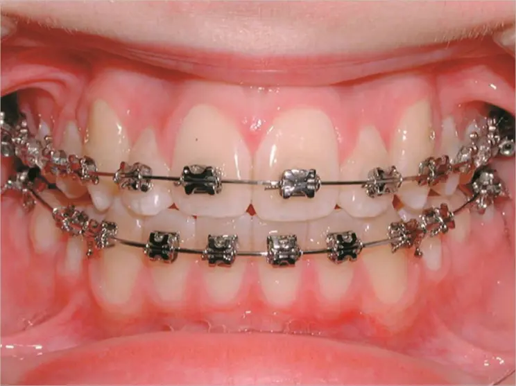 Orthodontic treatments