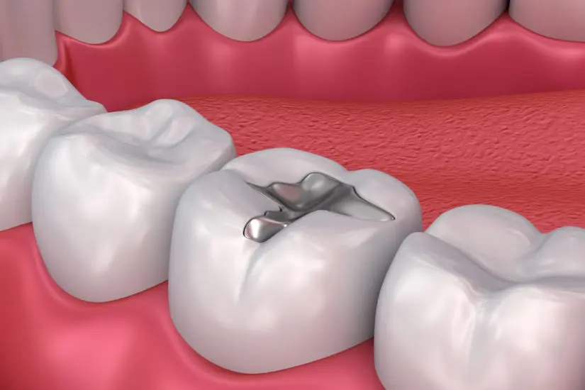 Dental fillings
