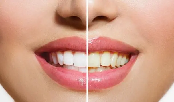 Teeth whitening