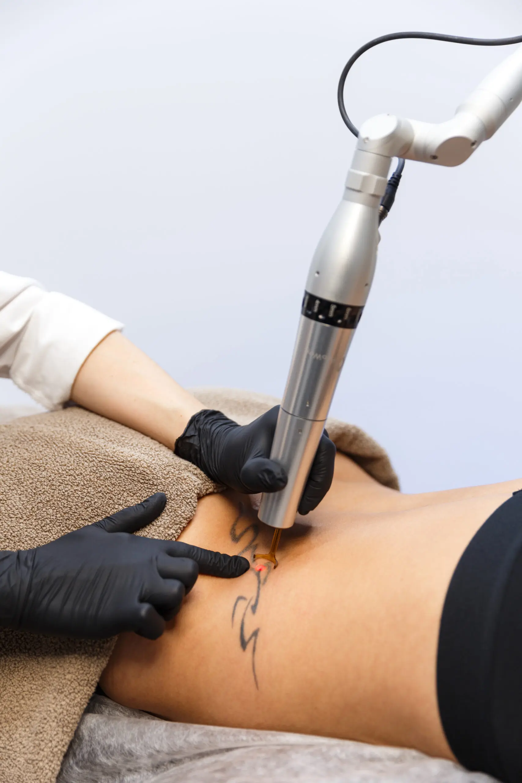 How Does Laser Tattoo Removal Treat Deep Ink Layers?
