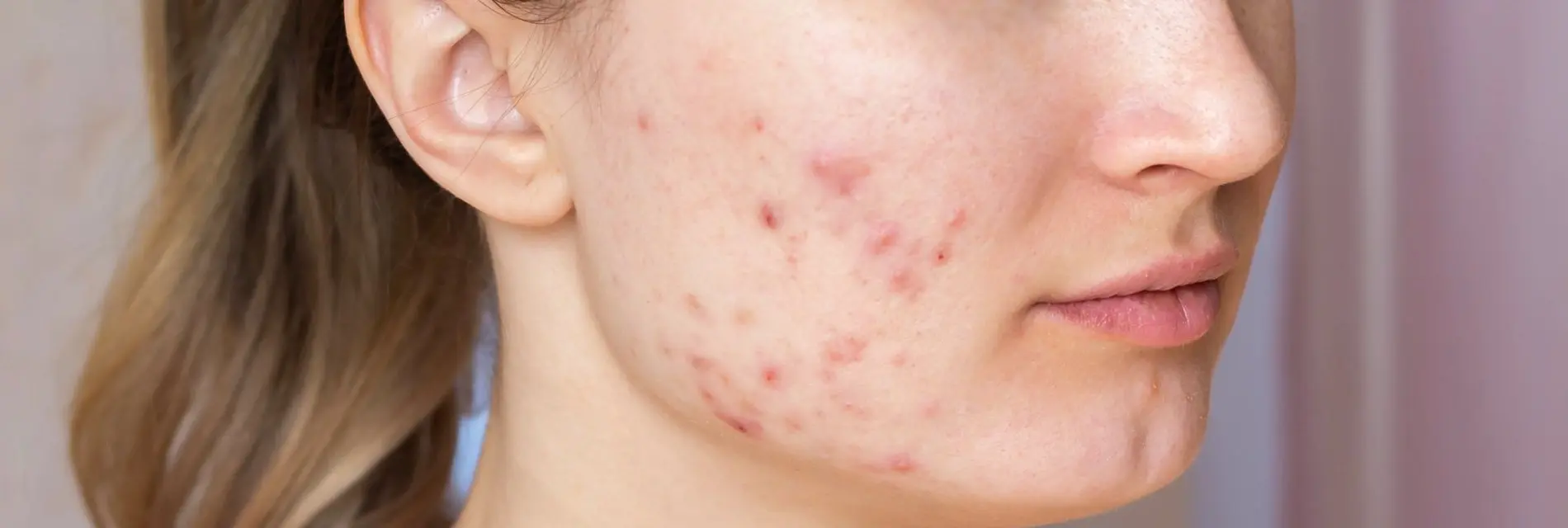 What Makes the Best Acne Treatment Work Effectively?