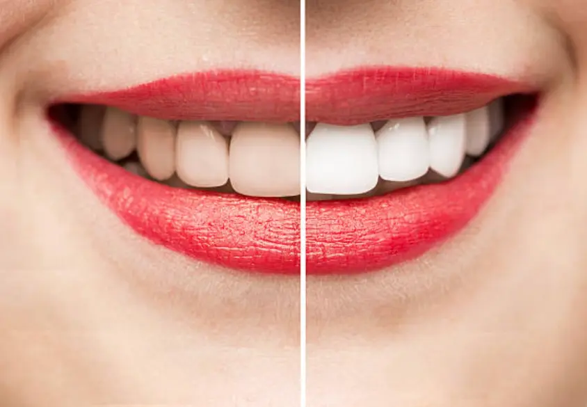 Teeth Whitening