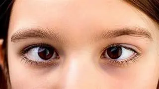 Pediatric Squint Treatment & Surgery