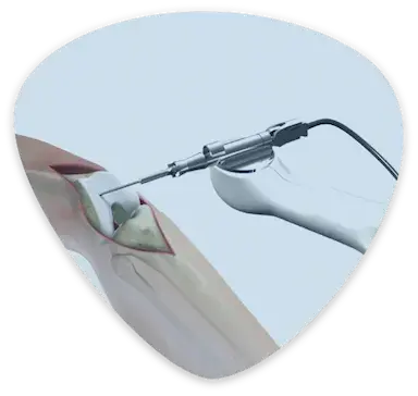 ROBOTIC PARTIAL KNEE REPLACEMENT