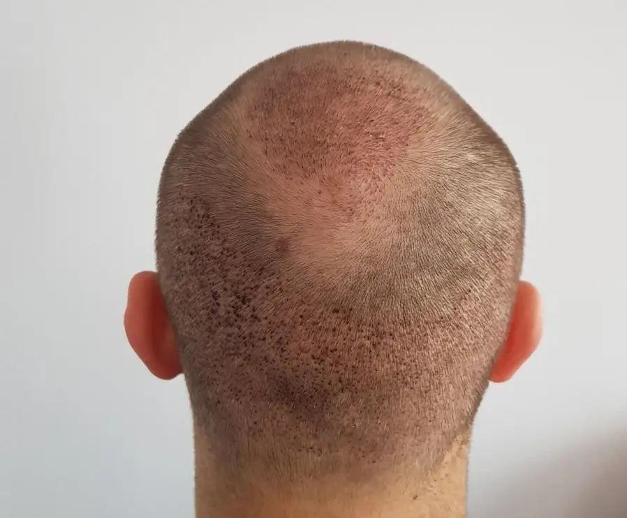 Is Hair Transplant a Good Option for Baldness?