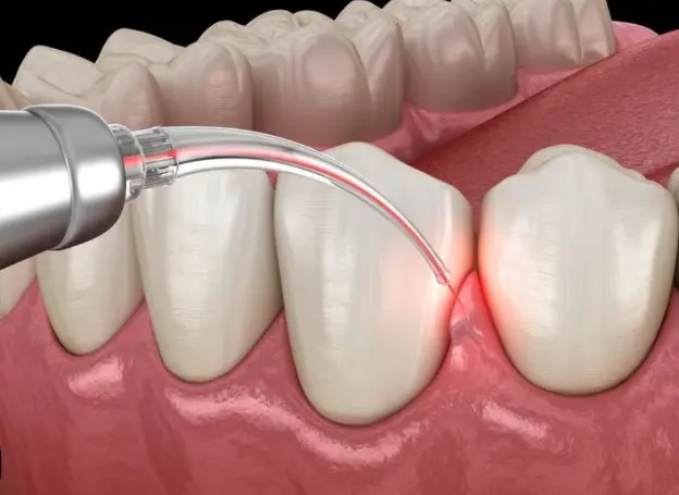 Laser Dentistry